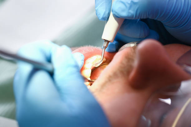 Best Emergency Tooth Extraction in Dalzell, SC